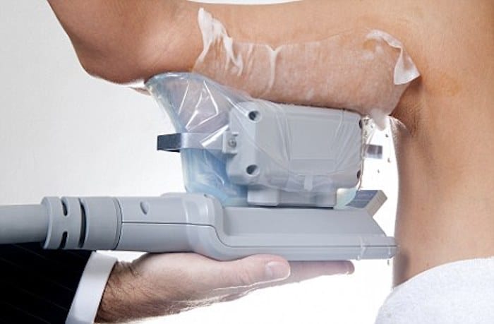 fat freezing arms Hartlepool