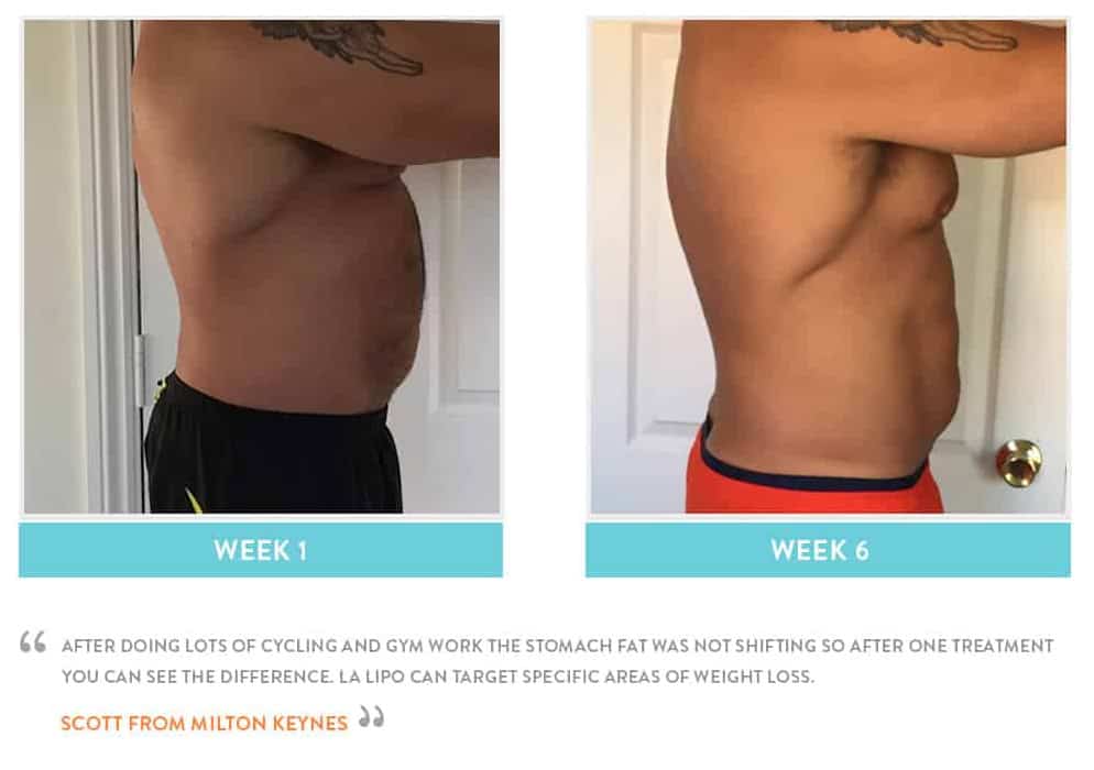 Before & After Stomach Fat Hartlepool