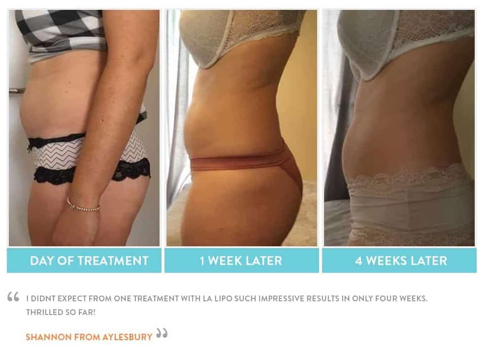 before, Cryolipolysis Hartlepool
