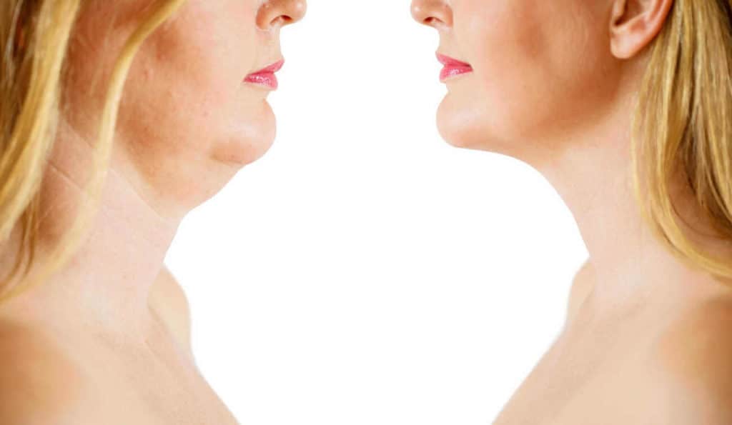 Double Chin treatment Hartlepool before and after results