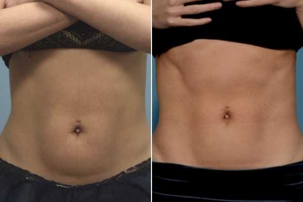 body sculpting FAQs Hartlepool