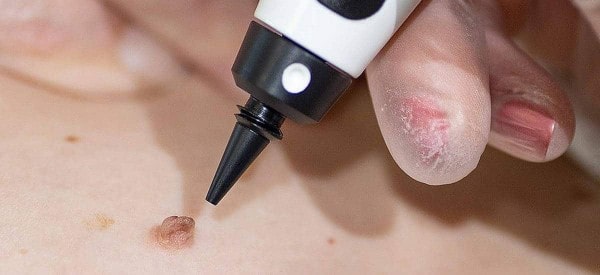After Skin Tag Removal Hartlepool