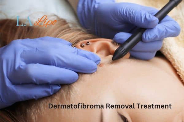 Dermatofibroma Removal Treatment Hartlepool
