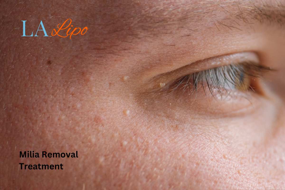 Cryopen Milia Removal: Is It the Easiest and Safest Option Hartlepool?