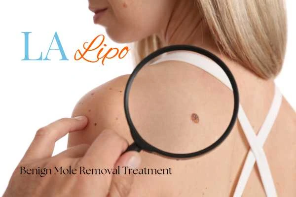 Woman having her inspection of blemish before mole removal Hartlepool