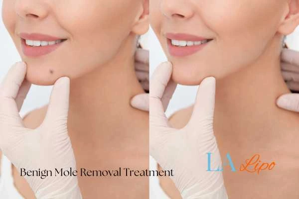 woman's before and after mole removal Hartlepool results