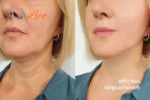 hi-fu for wrinkles Hartlepool before and after results