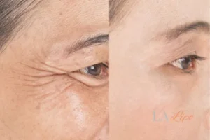 Before and after results of woman - HI-fu wrinkles reduction treatment Hartlepool