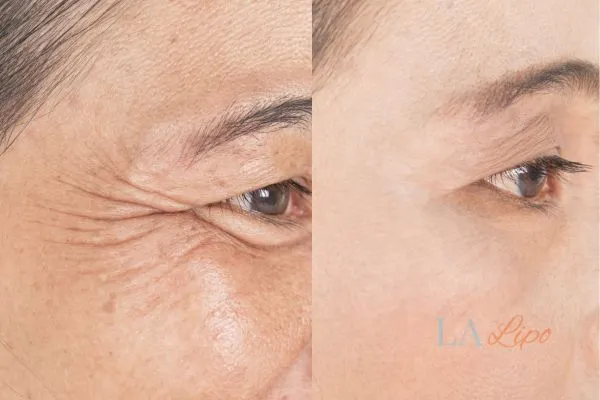 Before and after results of woman - HI-fu wrinkles reduction treatment Hartlepool