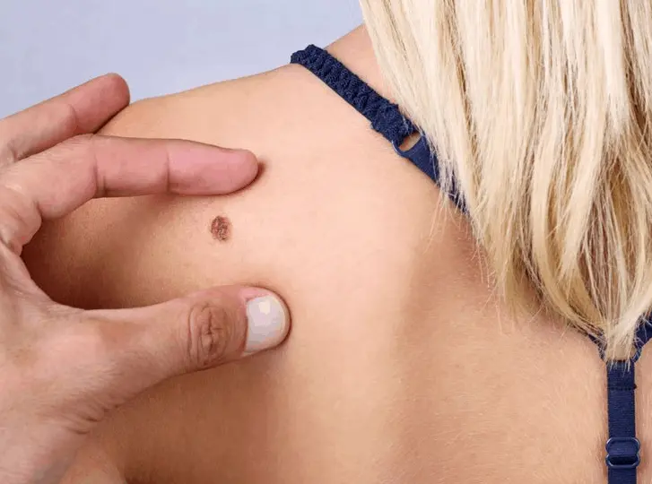woman having mole removal Hartlepool consultation before treatment.