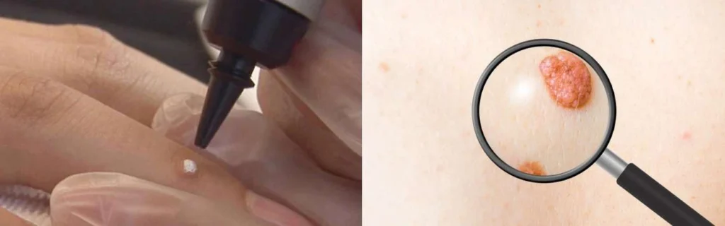CryoPen practitioner Hartlepool assessing a benign mole before treatment