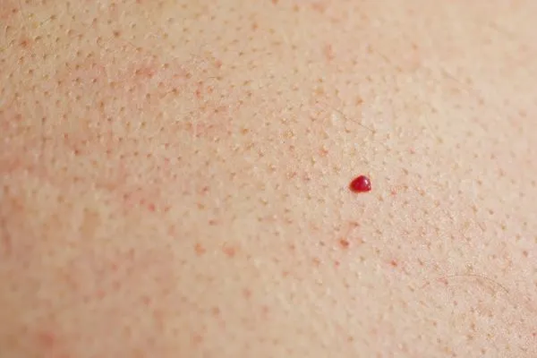 close up of a cherry angioma Hartlepool
