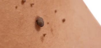 image of a skin tag Hartlepool