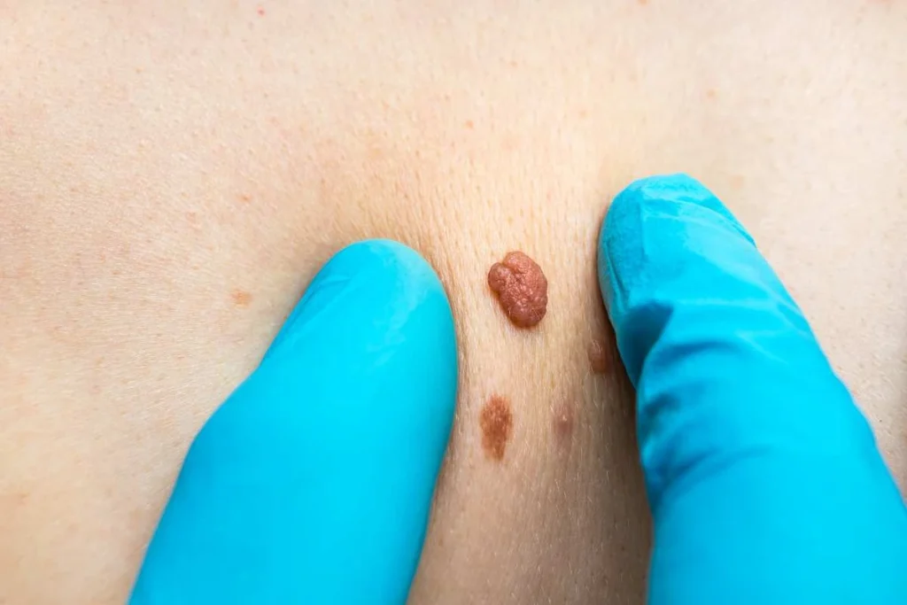 Consultant examining a skin tag Hartlepool
