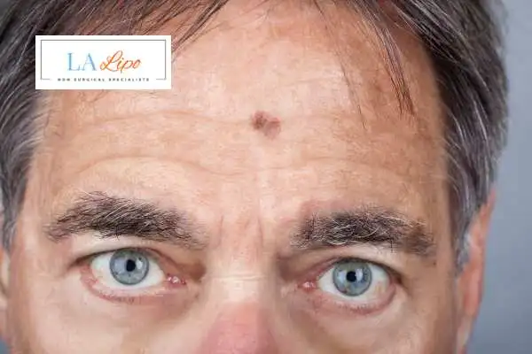 Solar Lentigo Removal Hartlepool image of man with mark on his forehead
