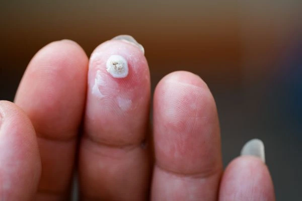 wart on person finger - cryotherapy to treat from LA LIPO Hartlepool