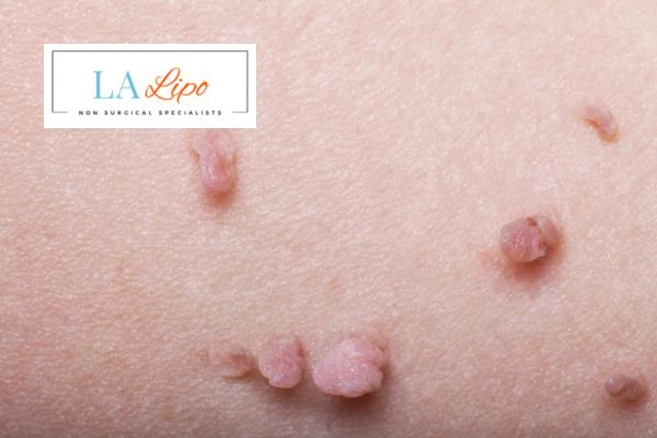 Does cryopen skin tag removal Hartlepool hurt? Find out now call our team today!