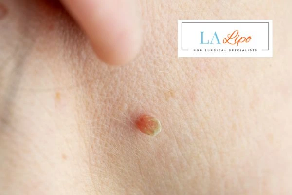 Book skin tag removal Hartlepool today speak to our team now!
