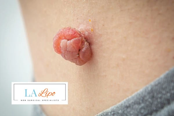 Interested in skin tag removal Hartlepool? Concerned about the pain? Find out more today!