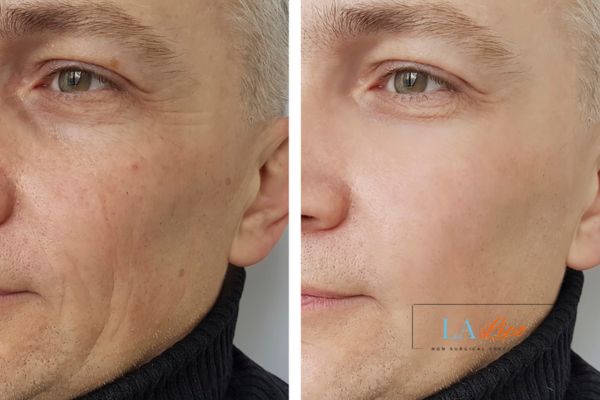See the amazing results of Morpheus8 Treatment Hartlepool!