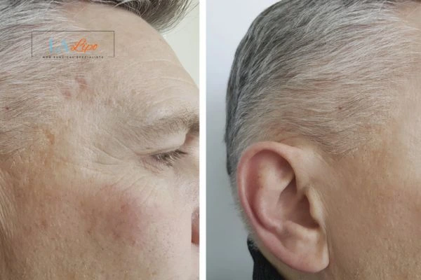 Mens Before & After Morpheus 8 Results Hartlepool