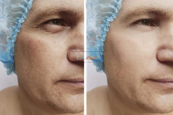 Before and after Morpheus 8 Results Hartlepool