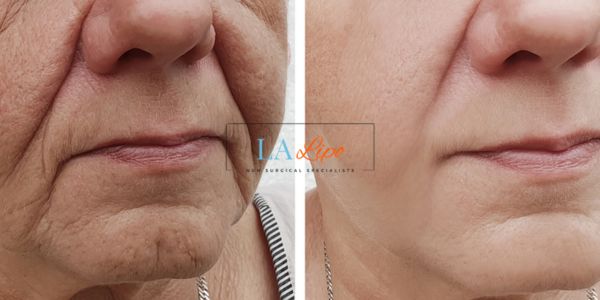 Older lady deeper wrinkle reduction - LA LIPO Morpheus 8 Results Hartlepool