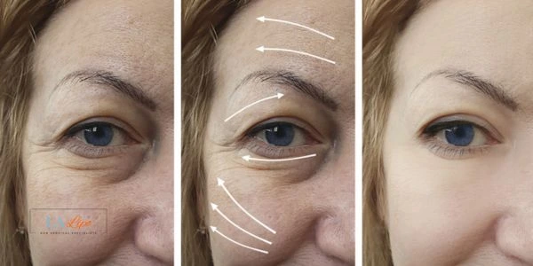 Amazing eye lift Morpheus 8 results Hartlepool