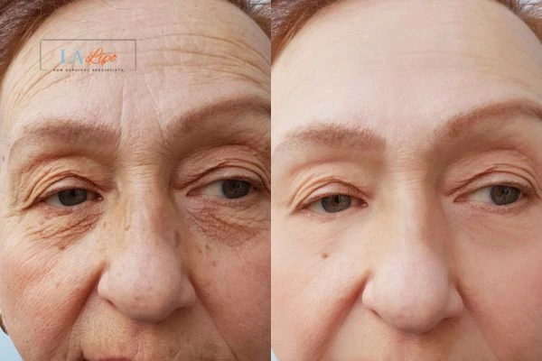 The powerful benefits of Morpheus8 Treatment Hartlepool - Call Our team today!