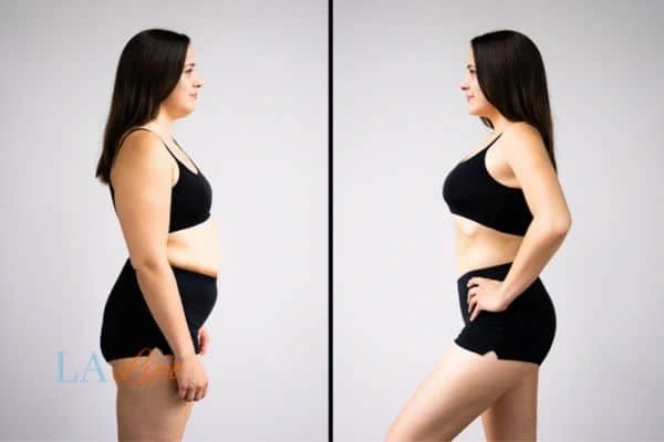 Picture of womans before and after using LA-EMS body sculpting to improve her core strength Hartlepool