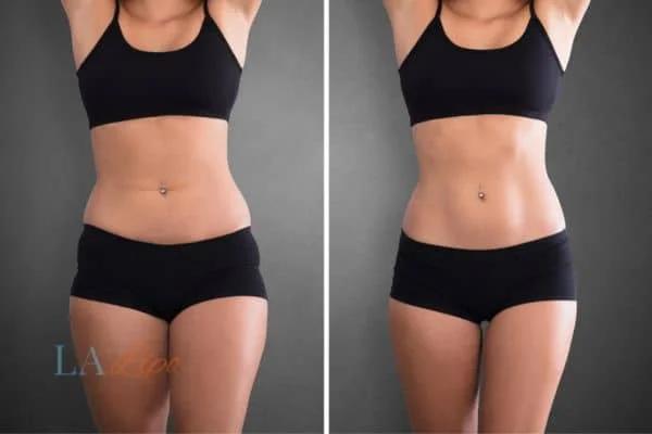 before and after results of non-surgical treatment to help a woman's body image and mental health Hartlepool