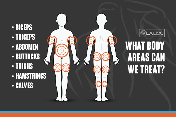 Diagram to show areas you can have LA-EMS Body Sculpting Treatment Hartlepool