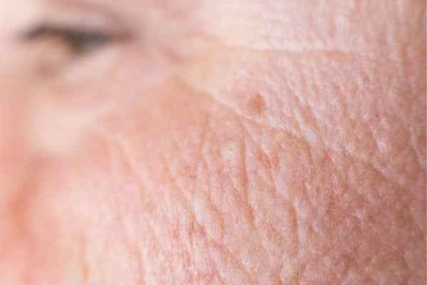 close up picture of a woman's face showing an age spot Hartlepool