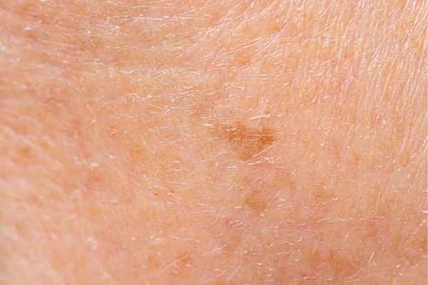 close up picture of age spots Hartlepool