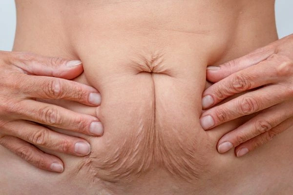 Should I Combine Diastasis Recti Treatment with Body Contouring for Better Results Hartlepool?