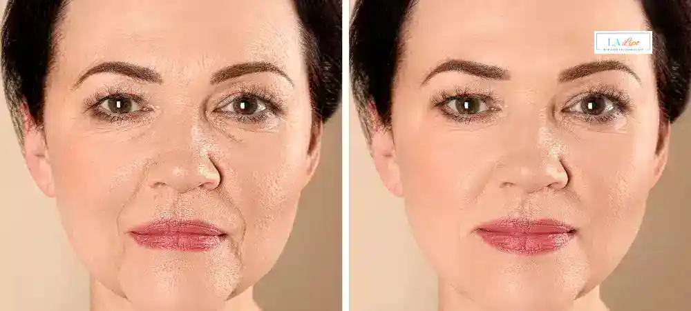 How Long Does It Take to See Results and How Long Do They Last Hartlepool?