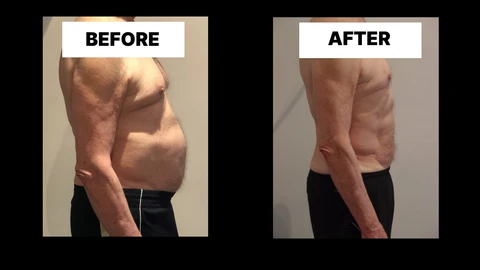 What Symptoms Can Diastasis Recti Cause in Men? Weak Core, Back Pain and Poor Posture Hartlepool